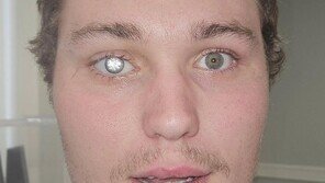 28억짜리 ‘다이아 눈’…시력 잃자 의안에 2캐럿 넣어