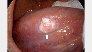 “입속 궤양 3주가 넘었는데 안 나아요”…‘이 질환’ 의심을