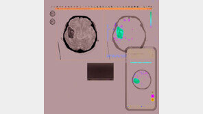 퍼플에이아이, 뇌졸중 진단 ‘3종 인공지능’ 포트폴리오 완성 [헬스케어 소식]
