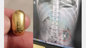 200만원 상당 ‘금콩’ 삼킨 中소년…모친 “밖에서 배변 안돼”