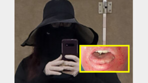 햇빛에 30초만 노출돼도 3도 화상…뱀파이어처럼 사는 英여성