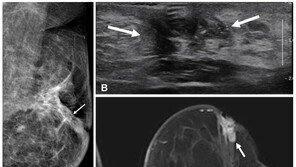 “50세이하 유방암, 수술전 ‘이 검사’ 하면 암재발 60%↓”