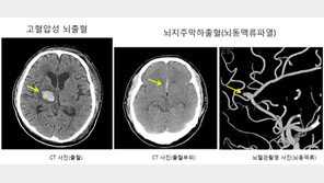 “망치로 맞은 듯한 극심한 두통”…‘이 질환’ 신호일 수도