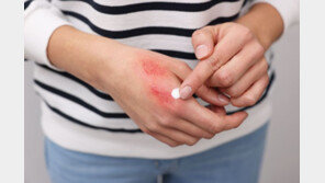 생명 앗아가는 화상 환자 ‘패혈증’…조기진단법 찾았다