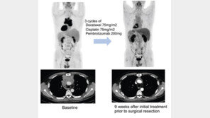 수술 불가 4기 흉선암, ‘이 함암제’ 효과…“세계 첫 확인”