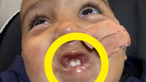 배수구 세정제를 우유처럼 ‘벌컥’…13개월 아기, 혀 절반 잃고 심장마비까지