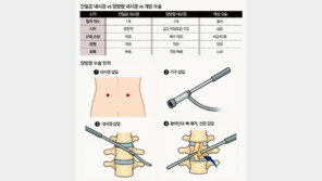 “내시경으로 척추 신경 압박만 콕 집어 해결… 고령도 수술 가능”