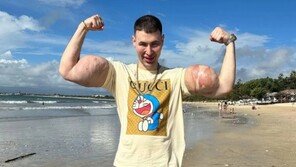 ‘러시아 뽀빠이 男’…과도한 약물 주사로 두 팔 잃을 위기