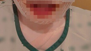 “아내 못생겨져야 안 떠날 것” 얼굴에 끓는 물 부은 남편