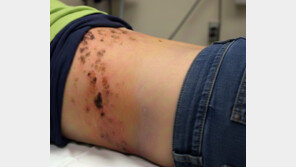 “감기몸살인줄 알았는데”…방치시 평생 신경통 ‘이 질환’