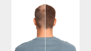 “대머리였어?” 결혼 1년만에 가발 착용 남편 고소