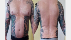 “붉은색 문신했다가” 전신 탈모, 피부 박탈, 무한증까지…