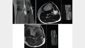 “말초신경 마비” 희귀질환 ‘신경내 결절종’…원인 찾았다