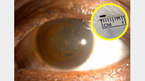 “앗! 눈에 티끌”…2년 방치했다가 실명 위기…알고보니 ‘쇳조각’