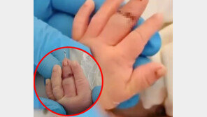 탯줄 자르다가 아기 손가락 절단…中간호사 황당 실수