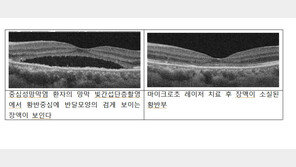 시야 중심 뿌얘지는 ‘중심성망막염’…‘이 치료’ 효과 입증