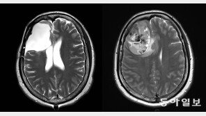 “갑자기 멍∼하고, 두통까지”… 건망증 아닌 뇌종양 신호일 수 있다[이진형의 뇌, 우리 속의 우주]