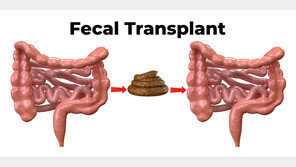 건강한 사람의 대변 이식, 암 치료의 ‘새 돌파구’ 될까
