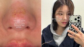 권은비 코·입술에 2도 화상…“새해 등산 도전 했다가”