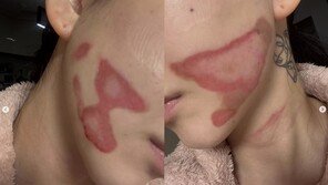 AOA 출신 권민아, 피부과 시술 중 ‘2도 화상’ 피해 “공황 찾아와…소송”