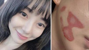 AOA 출신 권민아 “피부 시술로 2도 화상…살 찢어지는 고통”