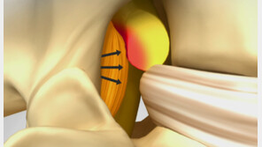 허리디스크 치료, 제거에서 보존 전환… ‘추간공확장술’ 주목