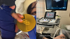 “뼈 3곳 부러지고도 날았나”…금메달 최가온, 골절 시사