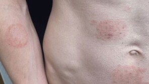 성접촉으로 퍼지는 ‘희귀 곰팡이’ 비상…미국서 집단 감염 발생