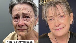 “30년 젊어졌다”…70세 여성, 안면거상 결과에 네티즌 감탄