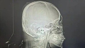 목에 12㎝ 젓가락 박힌 채로 8년 지낸 남성…뒤늦게 제거 수술