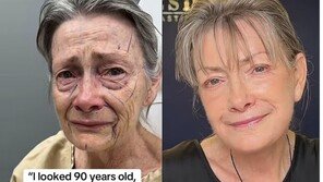 “주름 가득했던 70세 여성, 40대 같다”…‘이 수술’ 효과에 누리꾼 반응 폭발