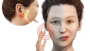 “이마 주름이 갑자기 펴졌어요”…‘안면마비’ 초기 증상?