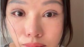 “눈이 안 감겨요”…무허가 쌍꺼풀 수술한 中여성 장애 판정