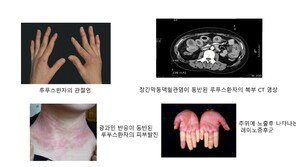 “장마철 관절이 욱신”…‘이 증상’ 겹치면 악화신호