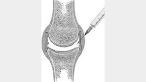 [일반건강]무릎관절 '홀뮴-키토산 복합제' 효과