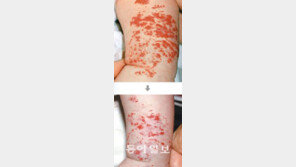 [헬스&뷰티]아기 피부의 ‘빨간 점’ 혈관종, 혈관 레이저로 뽀송뽀송···