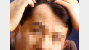 대머리 심할수록 남성의 중요한 ‘이곳’도 위험