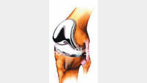 [헬스&뷰티/조재현 원장의 행복한 관절 이야기]<7> 인공관절 수술 전엔 복용하던 약 끊으세요