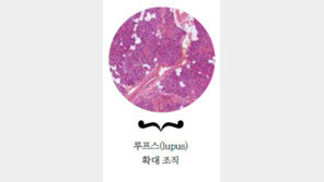 온몸을 괴롭히는 루푸스, 어떻게 이길까?