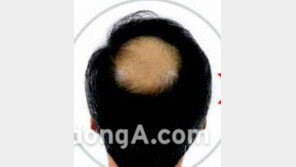 겨울에 머리 더 빠진다...이런증상 있는지 확인해보세요 탈모 체크 리스트 