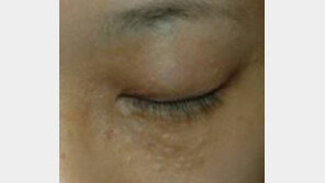 ‘편평사마귀 유행’ 20대女, 여드름인줄 알고 짰다가는 큰일...치료방법은?