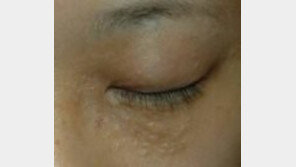 ‘편평사마귀 유행’, 물집 잡혀 병원 갔더니…