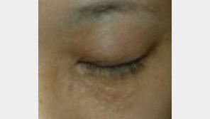 ‘편평사마귀 유행’ 피부에 이런증세 있으면 즉시 병원 찾으세요