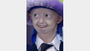 100년같은 17년의 삶… 英조로증 소녀 숨져