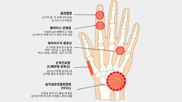 27개 뼈로 이뤄진 손…통증 부위별 의심되는 관절 질환은?