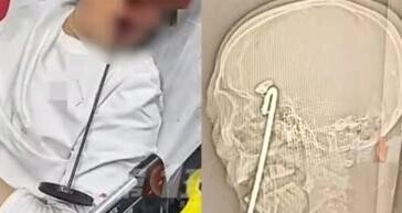 술 취해 넘어진 男 머리에 40cm 쇠막대 관통…기적 생존