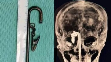 술 취해 넘어진 男 머리에 40cm 쇠막대 관통…기적 생존