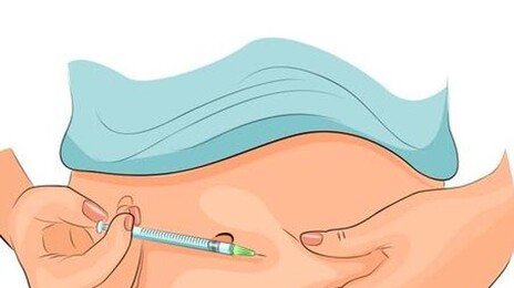 위에서 인슐린 만드는 기술 개발… ‘1형 당뇨’ 치료 길 연다
