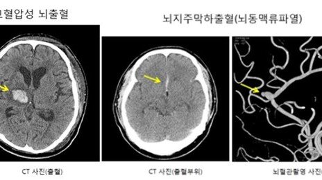 “망치로 맞은 듯한 극심한 두통”…‘이 질환’ 신호일 수도
