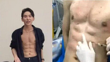 “운동 대신 주사 40번”…8억 들여 인공 복근 만든 中 남성
